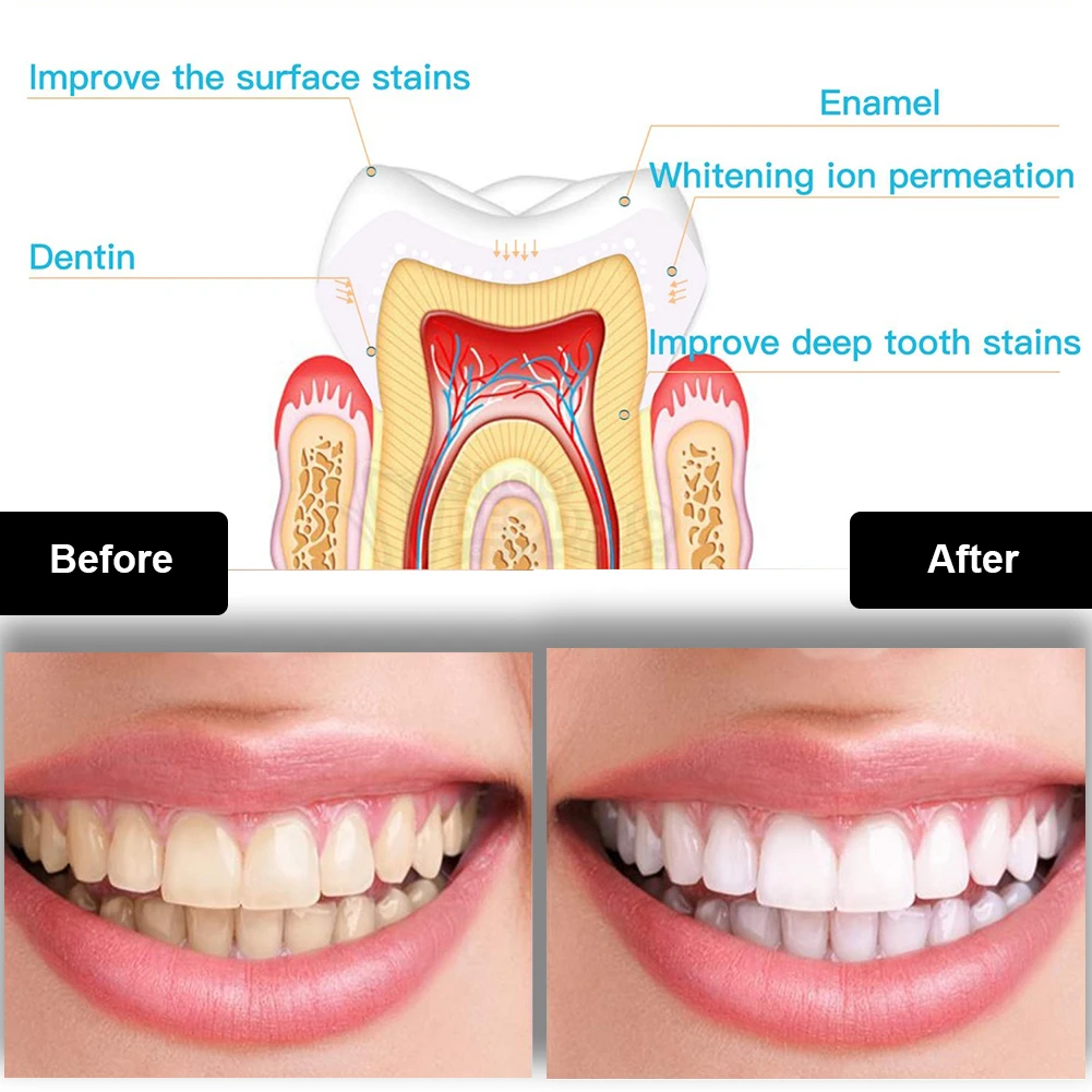Dental Zahnaufhellung Kit Mini – Teeth Whitening With Blue Light Bewertung und Preis