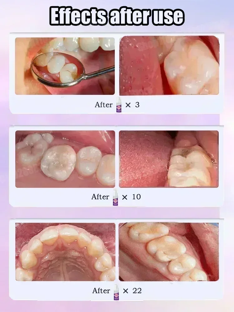 Zahnreinigungs-Zahnpasta entfe – Teeth Whitening Cream Bewertung und Preis